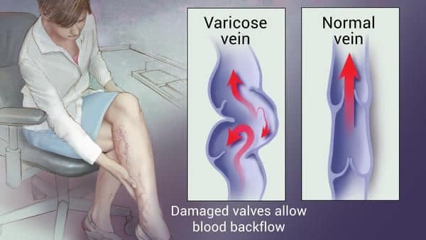 Name:  varicose veins 11.jpg
Views: 1244
Size:  30.7 KB