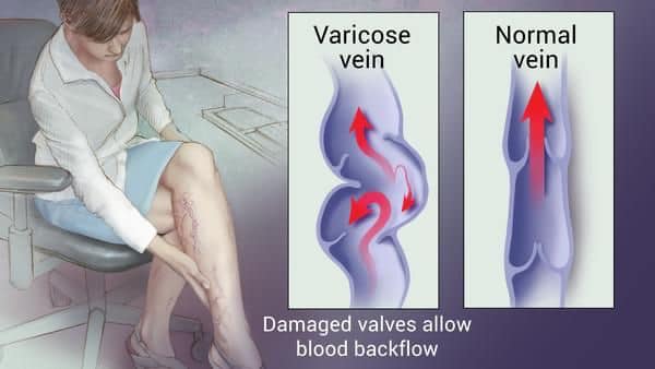 Name:  varicose veins 11.jpg
Views: 1236
Size:  30.7 KB